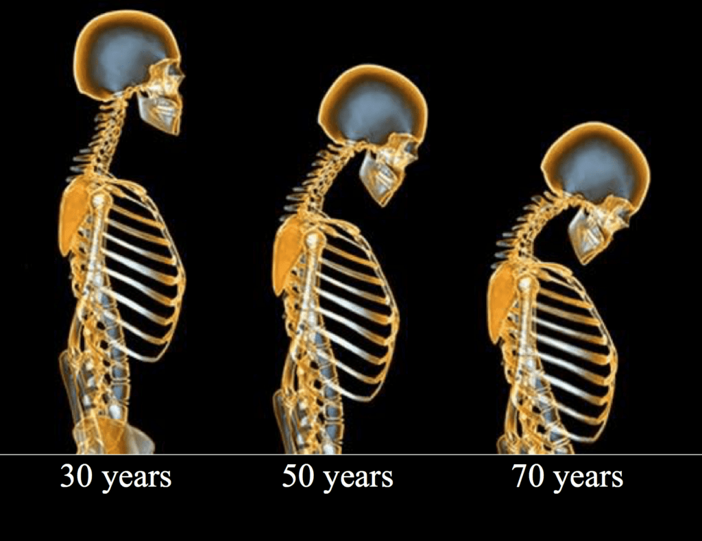 arthritis-aging